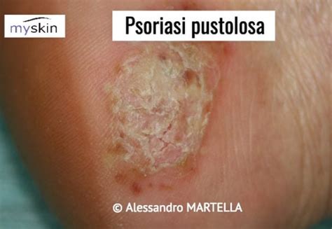 Psoriasi Dalla A Alla Z Myskin