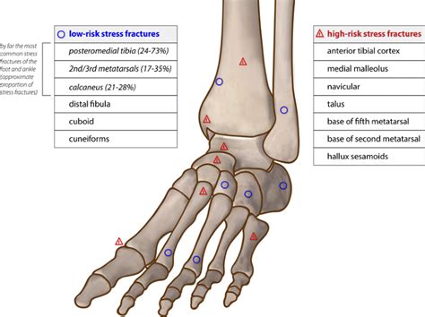 Stress Fractures Of The Foot And Ankle Part 2 Site Specific Etiology