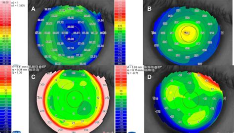 Post-LASIK corneal topography and pachymetry. A representative case at... | Download Scientific ...