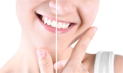 Teeth Whitening Myths Vs Facts Larry Molenda Dds