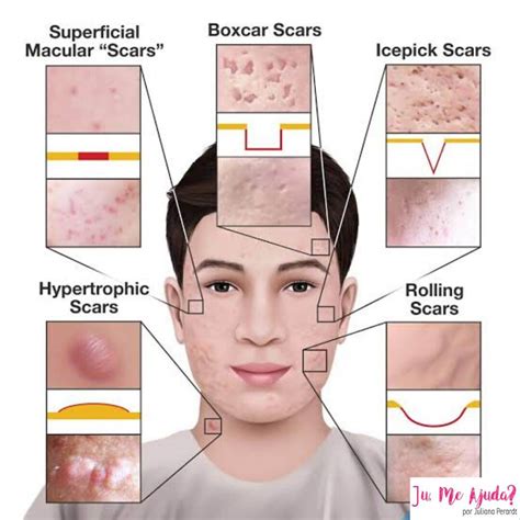 Tratamento Das Cicatrizes De Acne Dr Anderson