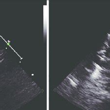 A Transthoracic Suprasternal Echocardiogram Showing Organized