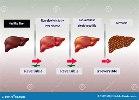 Liver Disease Stages