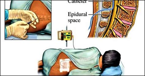 Epidural Analgesia For Labor What It Is And Side Effects