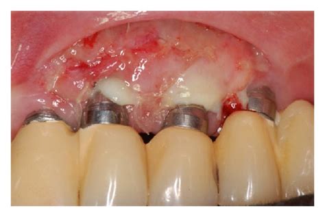 Postoperative Aspect 7 Days After Surgery Download Scientific Diagram