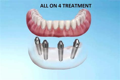 All On Treatment Center For Implant Dentistry