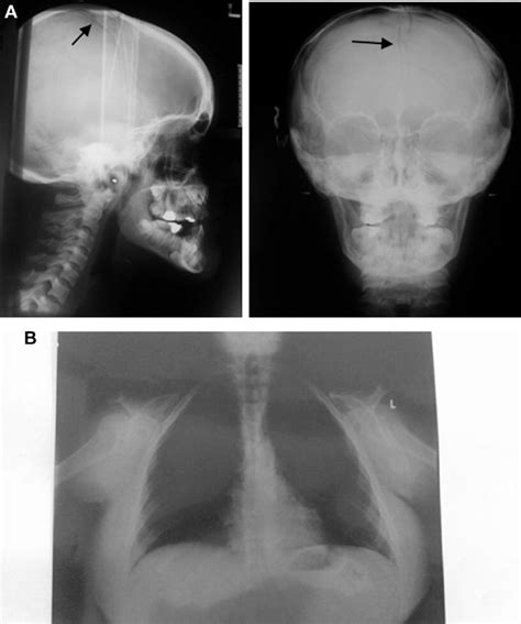 A Lateral And Anteroposterior Cephalograms Arrows Point To Open