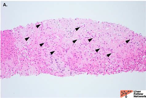 Pathology Pearls Amyloidosis Aasld