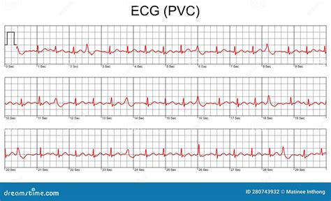 ECG Cardiogram.Cardiac Arrhythmia. Premature Ventricular Contraction ...