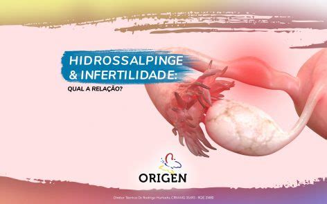 Hidrossalpinge E Infertilidade Qual A Rela O Cl Nica Origen