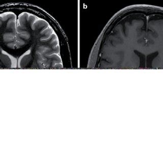 (PDF) [Differential diagnosis of bilateral thalamic lesions].