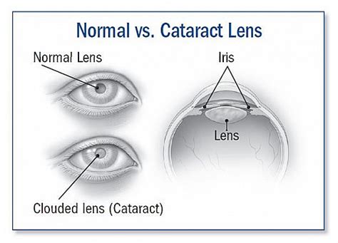 Cataract Symptoms Diagnosis And Treatment Harvard Health