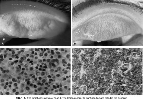 Figure 1 From Bilateral Conjunctival Mucosa Associated Lymphoid Tissue Lymphoma Misdiagnosed As