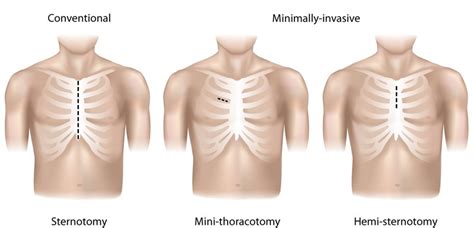 Adult Cardiothoracic Surgery Minimally Invasive Aortic Valve Surgery