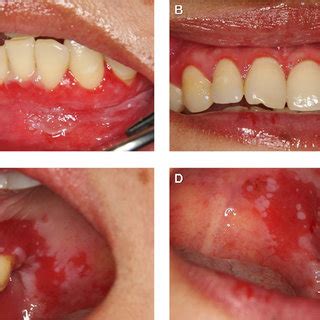 A Generalised Erythematous Marginal Gingiva On Upper Teeth B