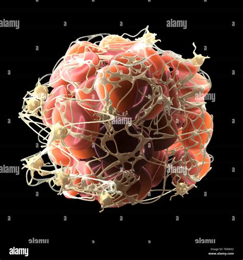 Thrombus In Bloodstream Blood Clot With Activated Platelets And Fibrin