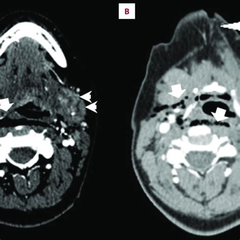 CT scan of the neck and axial images at the level of the submandibular... | Download Scientific ...