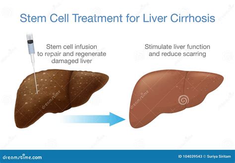 Liver Cirrhosis Treatment with Stem Cells. Stock Vector - Illustration of damage, disease: 104039543