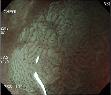 Magnification Endoscopy With Narrow Band Image Of Light Blue Crest Download Scientific Diagram