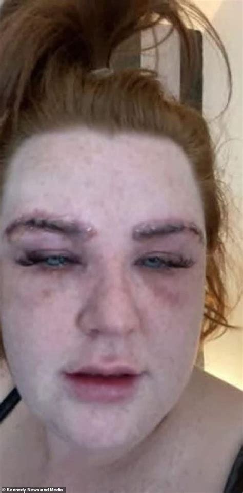 Woman’s eyebrows FELL OFF after allergic reaction to a wax and tint - Cedar News English