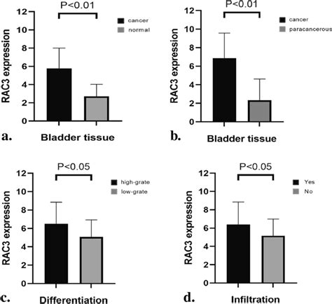 High Expression Of RAC3 In Bladder Tumor Tissues A RAC3 Expression In