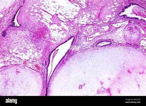 Le cancer du testicule Microphotographie lumière d une section à