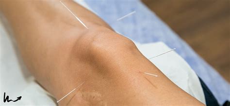 Differences Between Dry Needling And Acupuncture The Movement Laboratory