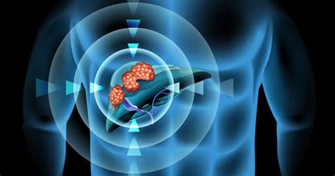 Erkennen Von Leberkrebs Durch Ultraschall Mit Kontrastmittel