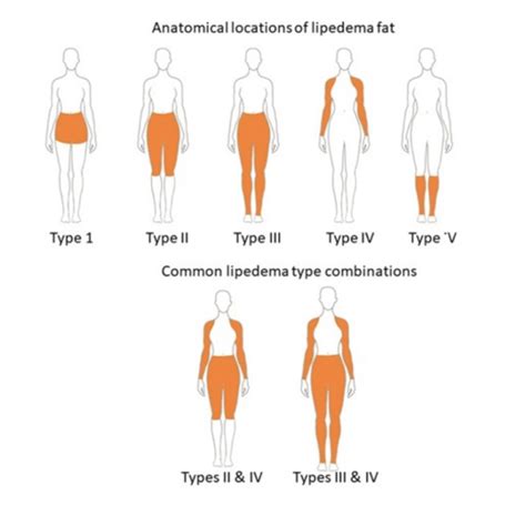 Lipedema Vs Cellulite Lipedema Stages And More