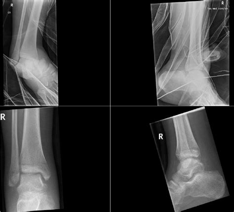 Top Left And Right X Ray Of A Right Ankle In Splint A Dislocated