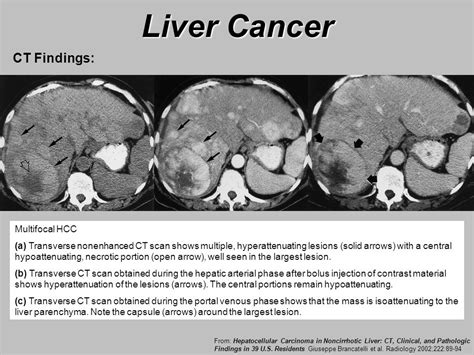 How Liver Cancer Spreads