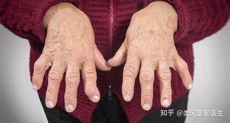 老年类风湿关节炎与年轻发病的类风湿关节炎 知乎