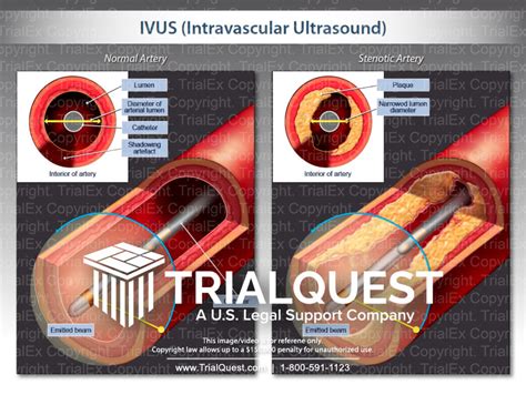 ivus intravascular ultrasound