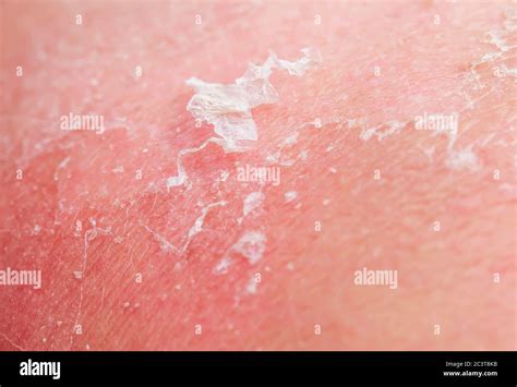 Background With The Texture Of Irritated Reddened Skin With Flaking