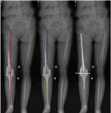 Leg Length Discrepancy After Hip Replacement Surgery Doctorvisit