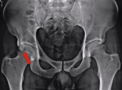 Preoperative Anteroposterior Pelvis Radiograph Showing The Lower Download Scientific Diagram