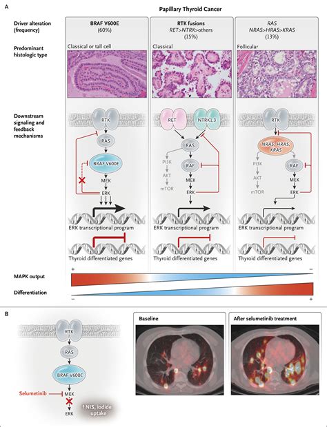 Biologic And Clinical Perspectives On Thyroid Cancer Nejm