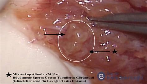 Ejaculate During Testicular Examination Telegraph