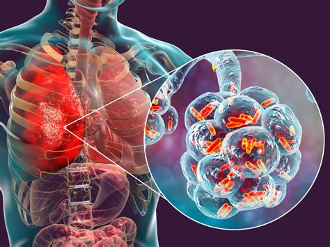 Optimizing Antimicrobial Management And Tackling Resistance In Gram