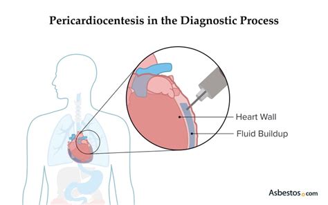 Pericardial Effusion Symptoms Causes And Treatments