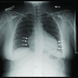 Chest X Ray Of Patient At Admission Showing Cardiomegaly With