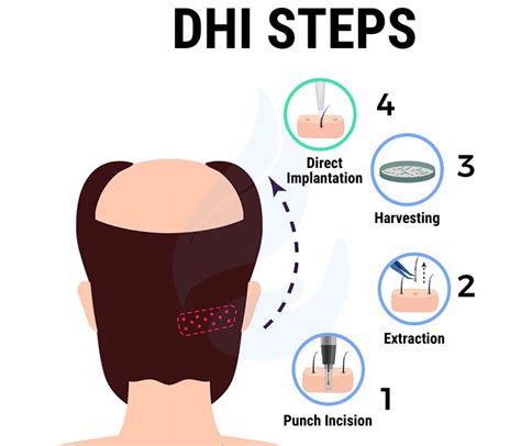 Hair Transplant Procedure Steps Clinic Effect