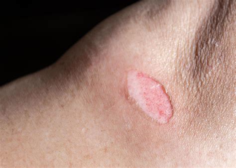 scab stock  images  backgrounds