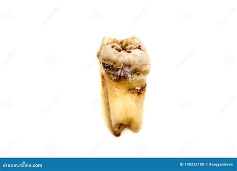 Get Decay Wisdom Teeth  Teeth Walls Collection For Everyone