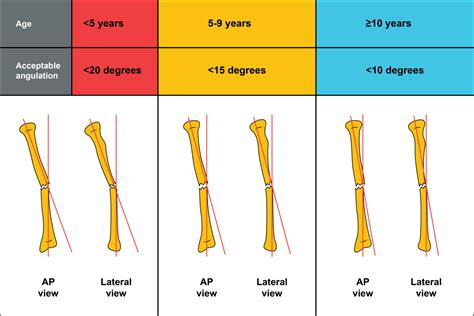 Radius And Ulna Shaft Fracture