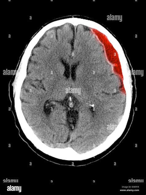 Ct Scan Showing A Subdural Hematoma Stock Photo Alamy