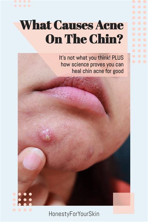 What Causes Acne On The Chin Plus What To Do About It Chin Acne