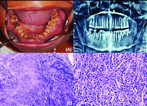 A Intra Oral Swelling Extending From Distal Of Permanent Left