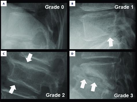 The Criteria For Visual Inspection Of A Lateral Lumbar Radiograph Using