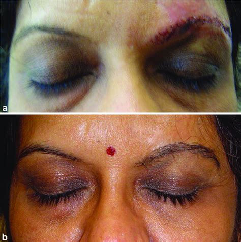 A Posttraumatic Scar Left Eyebrow Pre B Posttraumatic Eyebrow